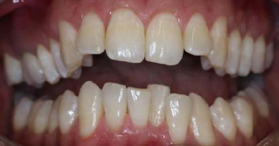 Patients teeth before Invisalign treatment at SET