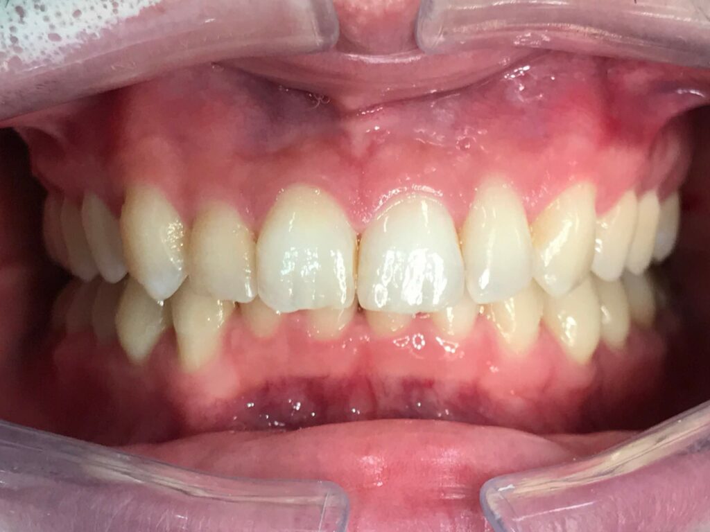 Patients teeth after Invisalign treatment at SET