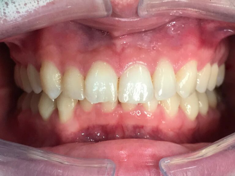Patients teeth after Invisalign treatment at SET