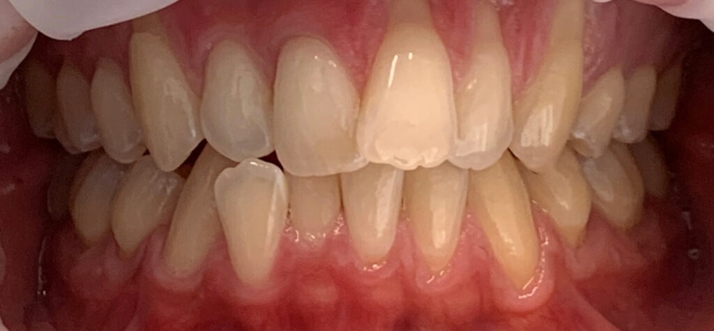 Patients teeth before Invisalign treatment at SET
