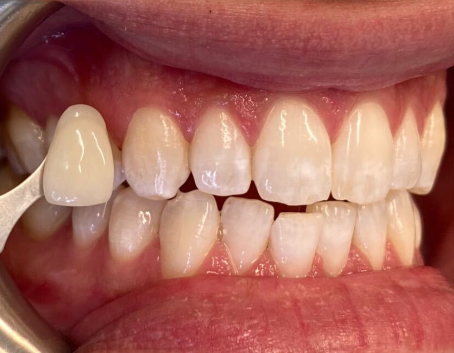 Photo of patients teeth after teeth whitening at SET