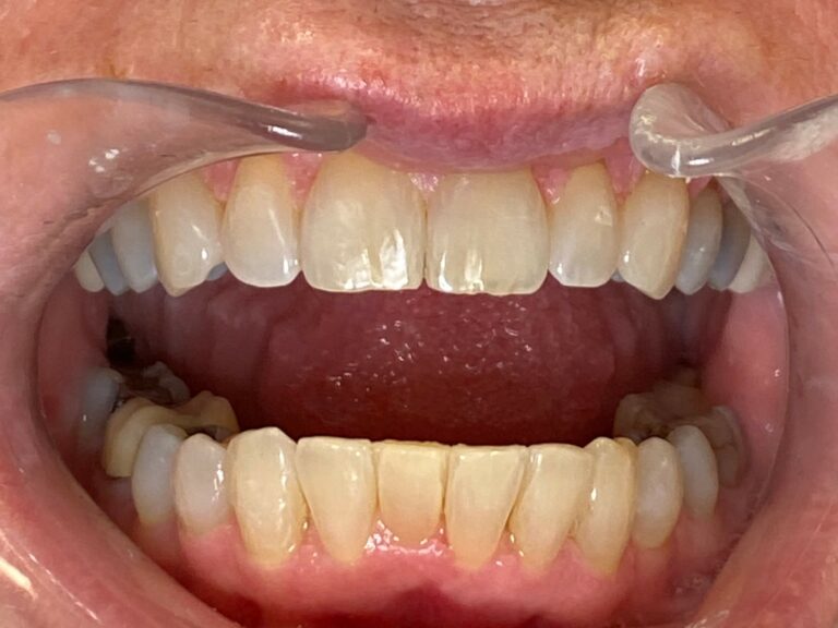 Teeth after Invisalign aligner treatment