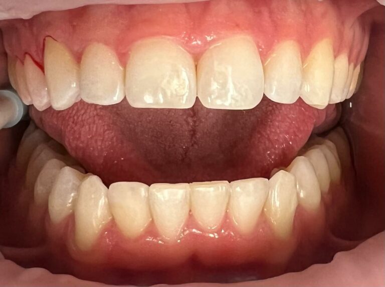Teeth after alignment at SET