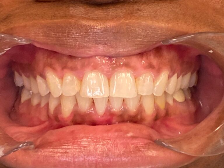 Teeth after Invisalign treatment