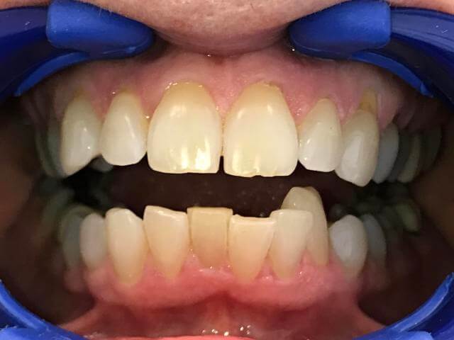 Teeth before Invisalign aligner treatment