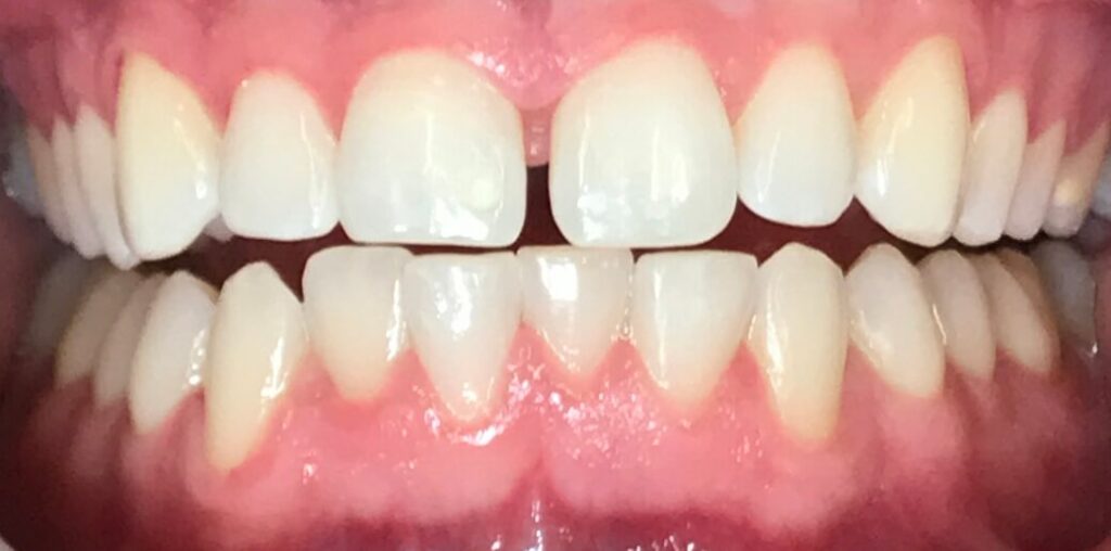 Teeth before alignment at SET