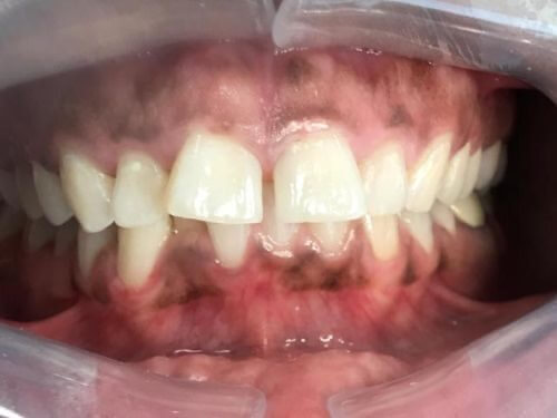 Teeth before Invisalign treatment
