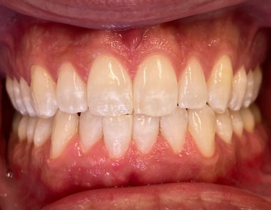 Teeth after whitening example