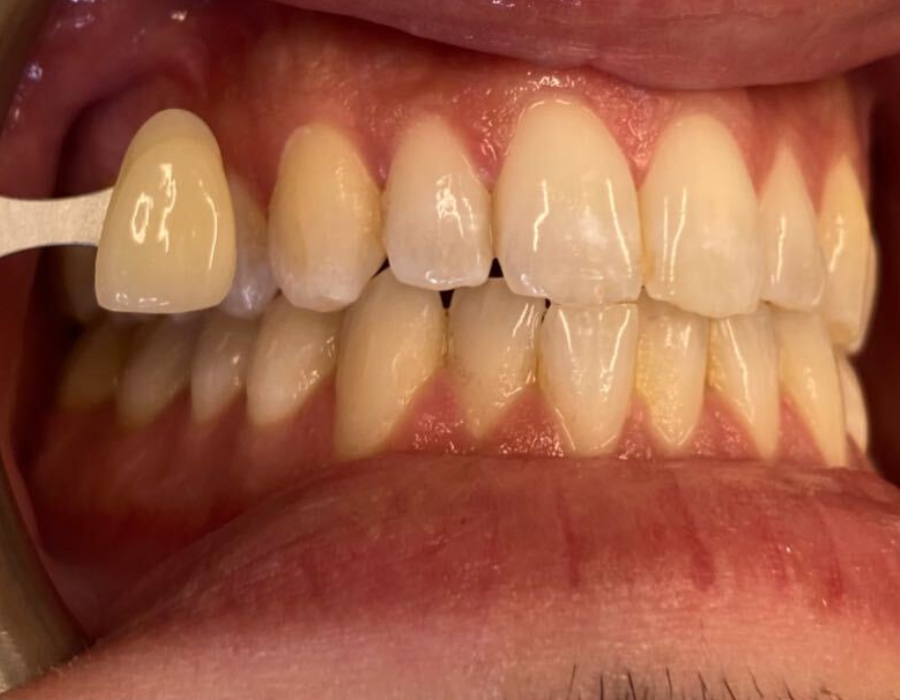 Photo of patients teeth before teeth whitening at SET