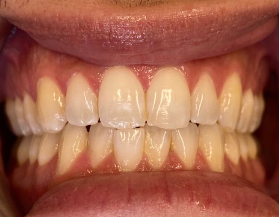 Teeth before whitening