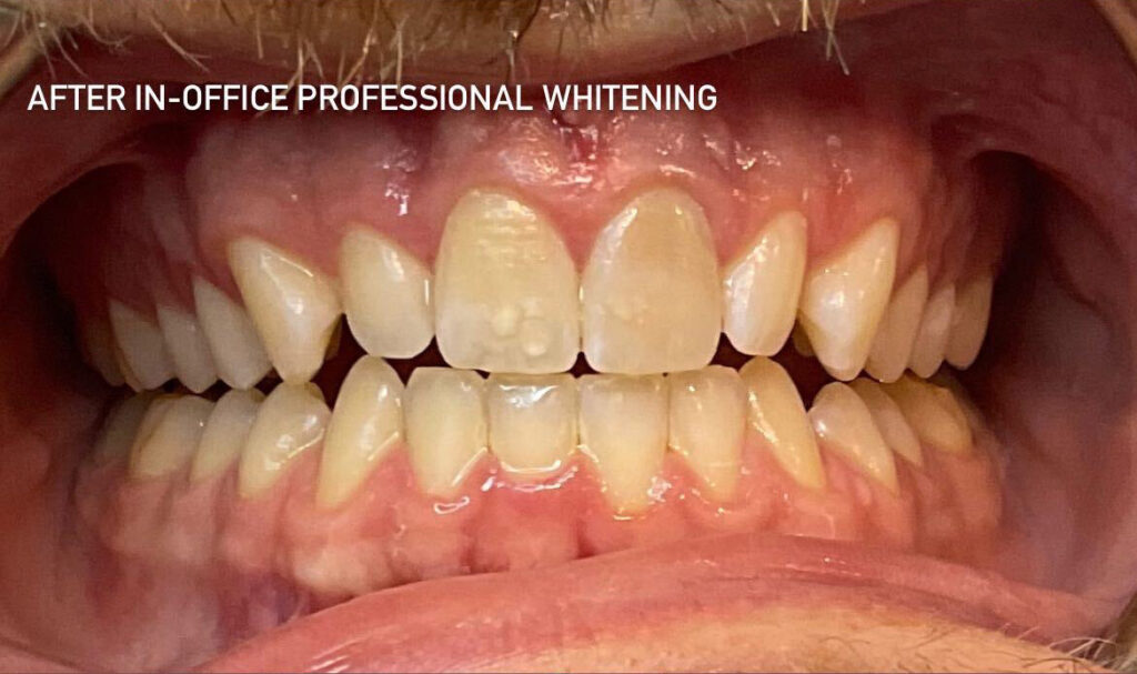 Patients teeth after in-office professional teeth whitening treatment