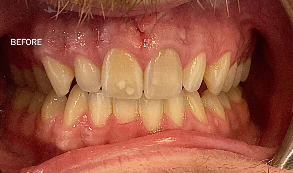 Patients teeth before in-office professional teeth whitening treatment