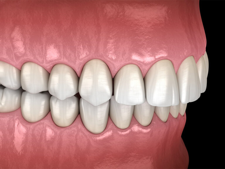 an illustration showing an overbite