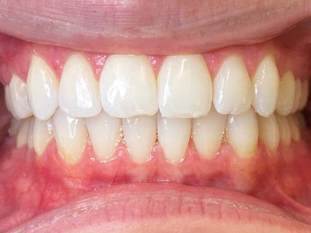 Patient Teeth After Invisalign