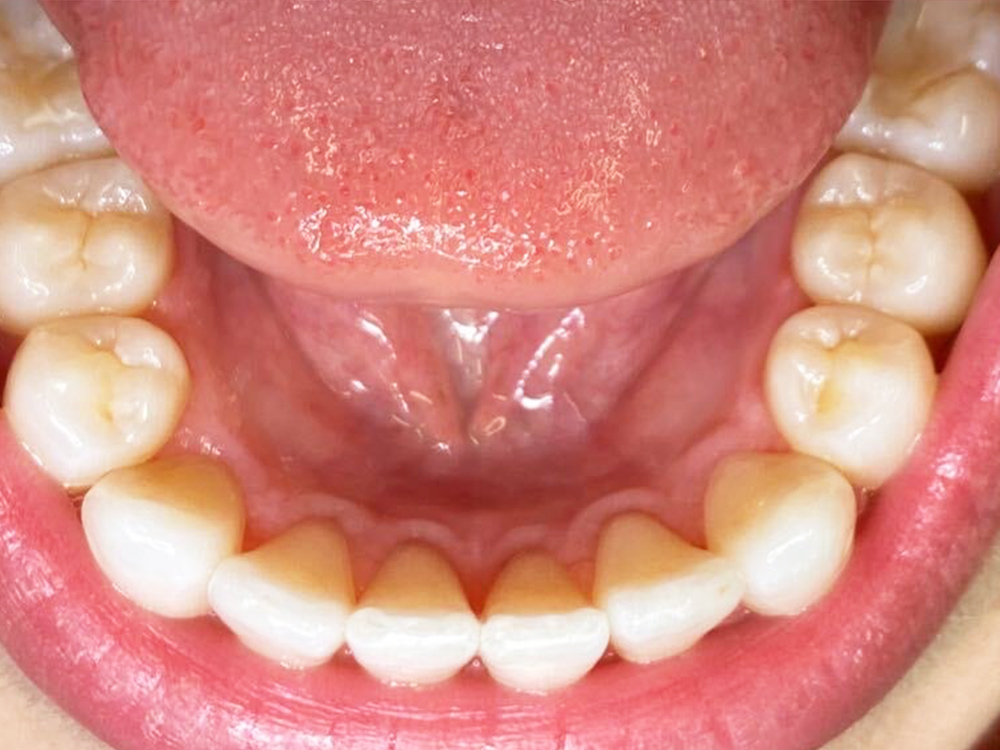 Patient Teeth After Invisalign