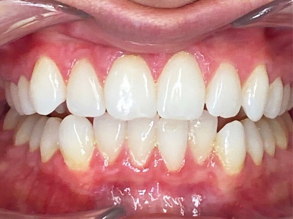 Patient Teeth Before Invisalign
